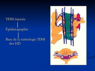 TDM injectée Épidurographie Base de la sémiologie TDM des HD 