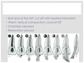 • Butt end of the GP: cut off with heated instrument
• Warm vertical compaction: coronal GP
• Chamber cleaned
• Restoration placed
 