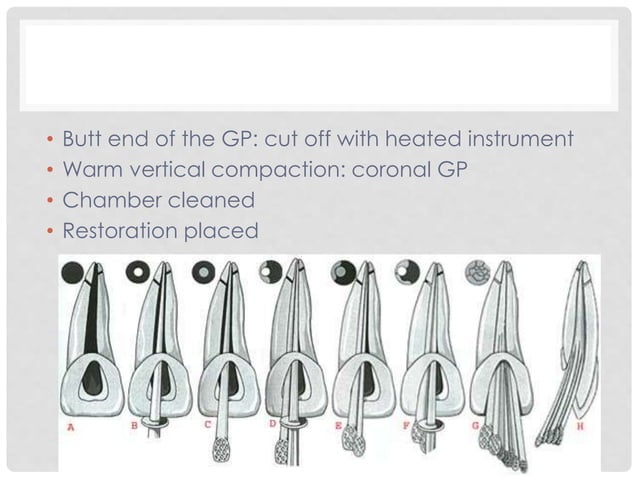 Techniques of Root Canal Obturation | PPTX | Medical Health