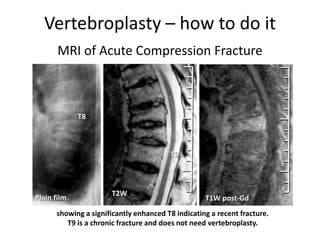 Vertebroplasty – how to do it
MRI of Acute Compression Fracture
T8
Plain film
T8
T2W
T8
T1W post-Gd
showing a significantly enhanced T8 indicating a recent fracture.
T9 is a chronic fracture and does not need vertebroplasty.
 