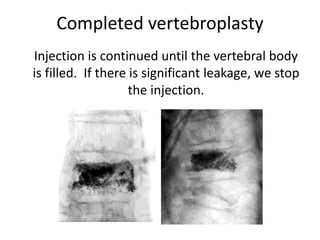 Completed vertebroplasty
Injection is continued until the vertebral body
is filled. If there is significant leakage, we stop
the injection.
 