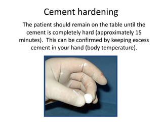 Cement hardening
The patient should remain on the table until the
cement is completely hard (approximately 15
minutes). This can be confirmed by keeping excess
cement in your hand (body temperature).
 