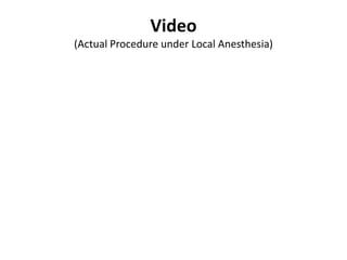 Video
(Actual Procedure under Local Anesthesia)
 