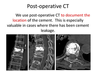 Post-operative CT
We use post-operative CT to document the
location of the cement. This is especially
valuable in cases where there has been cement
leakage.
 