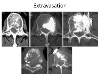 Extravasation
 