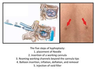 The five steps of kyphoplasty:
1. placement of Needle
2. insertion of a working cannula
3. Reaming working channels beyond the cannula tips
4. Balloon insertion, inflation, deflation, and removal
5. injection of void filler
 