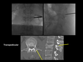 Transpedicular
 