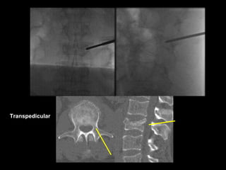 Transpedicular
 