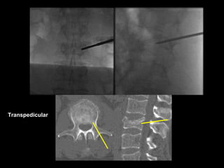 Transpedicular
 