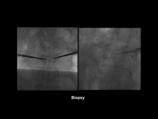 Biopsy
 