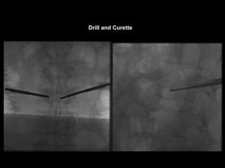 Drill and Curette
 