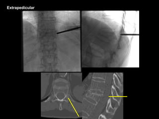Extrapedicular
 