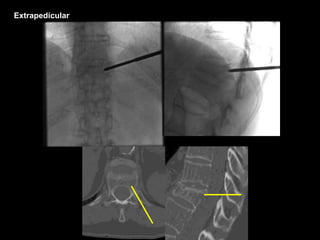 Extrapedicular
 