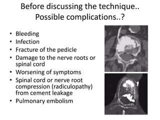 Before discussing the technique..
Possible complications..?
• Bleeding
• Infection
• Fracture of the pedicle
• Damage to the nerve roots or
spinal cord
• Worsening of symptoms
• Spinal cord or nerve root
compression (radiculopathy)
from cement leakage
• Pulmonary embolism
 