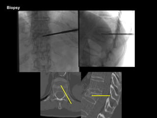 Biopsy
 