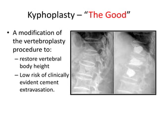 Kyphoplasty – “The Good”
• A modification of
the vertebroplasty
procedure to:
– restore vertebral
body height
– Low risk of clinically
evident cement
extravasation.
 
