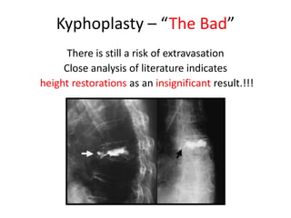 Kyphoplasty – “The Bad”
There is still a risk of extravasation
Close analysis of literature indicates
height restorations as an insignificant result.!!!
 