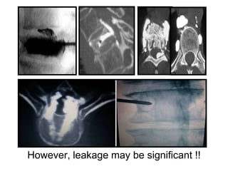 However, leakage may be significant !!
 