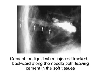 Cement too liquid when injected tracked
backward along the needle path leaving
cement in the soft tissues
 