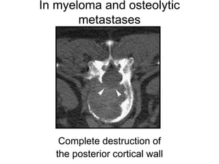 In myeloma and osteolytic
metastases
Complete destruction of
the posterior cortical wall
 