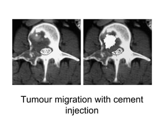 Tumour migration with cement
injection
 