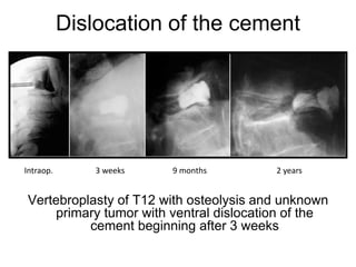 Dislocation of the cement
Vertebroplasty of T12 with osteolysis and unknown
primary tumor with ventral dislocation of the
cement beginning after 3 weeks
9 months 2 years3 weeksIntraop.
 