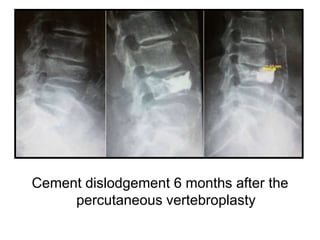 Cement dislodgement 6 months after the
percutaneous vertebroplasty
 