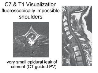 C7 & T1 Visualization
fluoroscopically impossible
shoulders
very small epidural leak of
cement (CT guided PV)
 