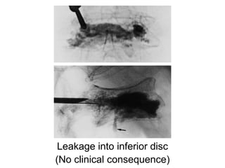 Leakage into inferior disc
(No clinical consequence)
 