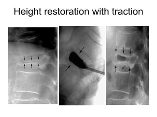 Height restoration with traction
 