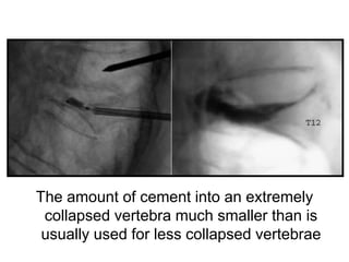 The amount of cement into an extremely
collapsed vertebra much smaller than is
usually used for less collapsed vertebrae
 
