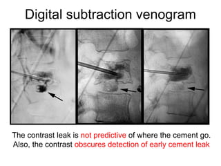 Digital subtraction venogram
The contrast leak is not predictive of where the cement go.
Also, the contrast obscures detection of early cement leak
 