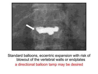 Standard balloons, eccentric expansion with risk of
blowout of the vertebral walls or endplates
a directional balloon tamp may be desired
 