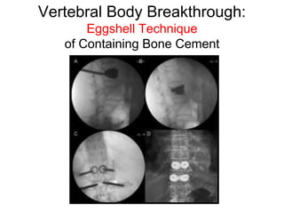 Vertebral Body Breakthrough:
Eggshell Technique
of Containing Bone Cement
 