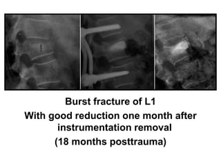 Burst fracture of L1
With good reduction one month after
instrumentation removal
(18 months posttrauma)
 