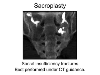 Sacroplasty
Sacral insufficiency fractures
Best performed under CT guidance.
 