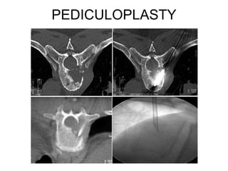 PEDICULOPLASTY
 