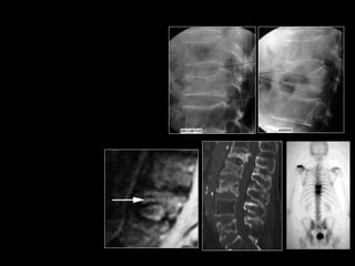 Vertebroplasty and KyphoplastyTechniques