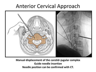 Anterior Cervical Approach
Manual displacement of the carotid–jugular complex
Guide needle insertion
Needle position can be confirmed with CT.
 