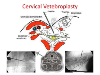 Cervical Vetebroplasty
 