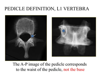 PEDICLE DEFINITION, L1 VERTEBRA
The A-P image of the pedicle corresponds
to the waist of the pedicle, not the base
 