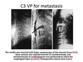 C3 VP for metastasis
The needle was inserted with finger compression of the visceral tissue (left).
Bone cement was injected into the C3 vertebral body, and
simultaneously an esophagogram was performed to check the
esophageal injury (middle). Postoperative lateral view (right).
 