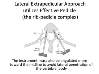 Lateral Extrapedicular Approach
utilizes Effective Pedicle
(the rib-pedicle complex)
The instrument must also be angulated more
toward the midline to avoid lateral penetration of
the vertebral body
 