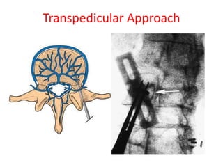 Transpedicular Approach
 
