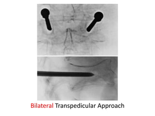 Bilateral Transpedicular Approach
 
