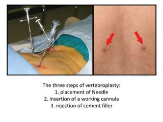The three steps of vertebroplasty:
1. placement of Needle
2. insertion of a working cannula
3. injection of cement filler
 