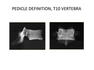 PEDICLE DEFINITION, T10 VERTEBRA
T10T10
 