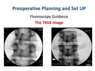 Preoperative Planning and Set UP
Fluoroscopy Guidance
The TRUE image
 