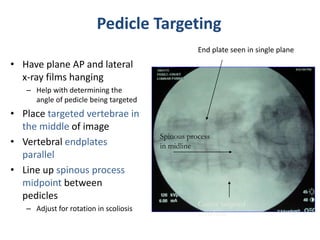 • Have plane AP and lateral
x-ray films hanging
– Help with determining the
angle of pedicle being targeted
• Place targeted vertebrae in
the middle of image
• Vertebral endplates
parallel
• Line up spinous process
midpoint between
pedicles
– Adjust for rotation in scoliosis
Pedicle Targeting
Spinous process
in midline
End plate seen in single plane
Center targeted
vertebrae
 