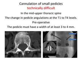 Cannulation of small pedicles
technically difficult
In the mid-upper thoracic spine
The change in pedicle angulations at the T1 to T4 levels.
Pre-operative
The pedicle must have a width of at least 3 to 4 mm.
 